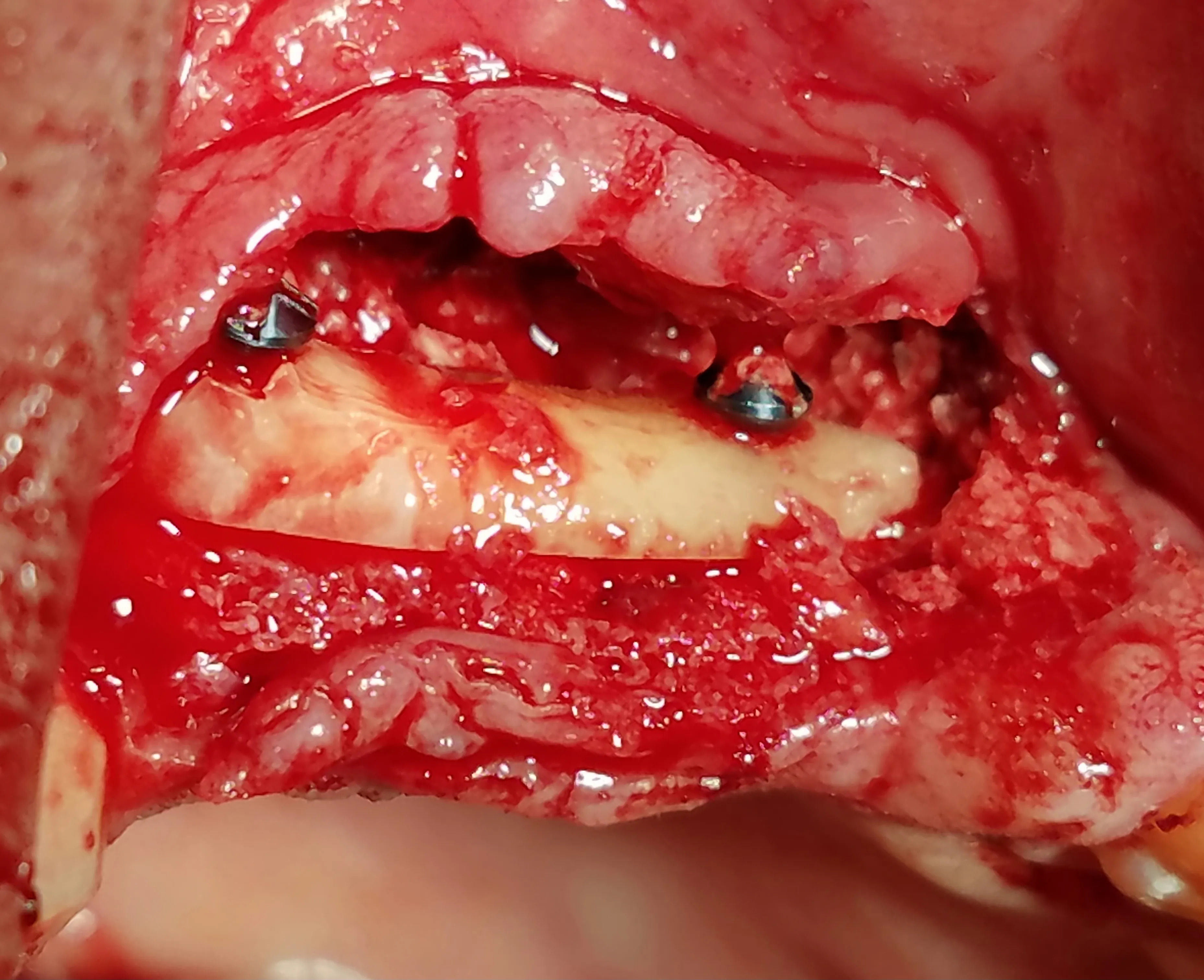 Alveolar ridge augmentation