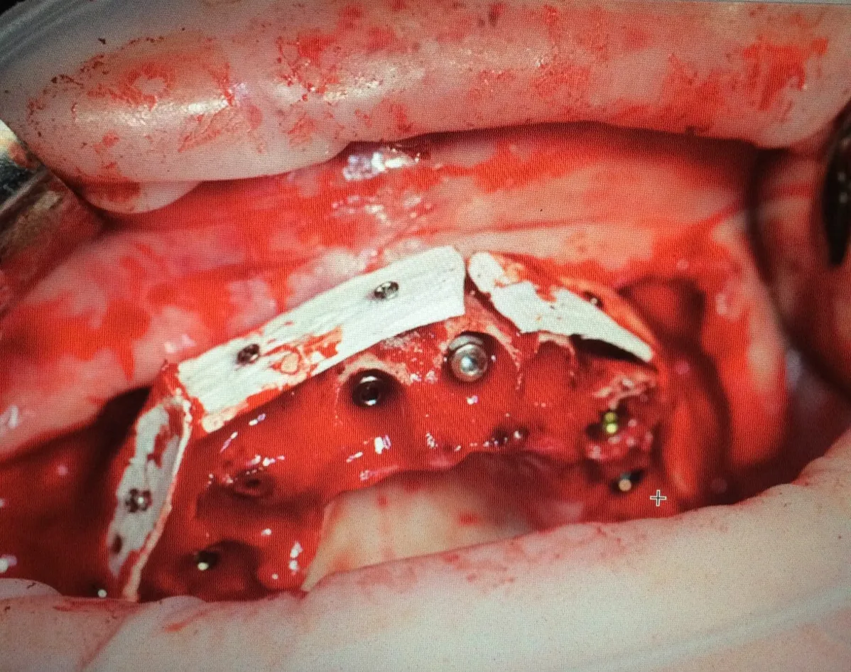Vertical augmentation with titanium mesh